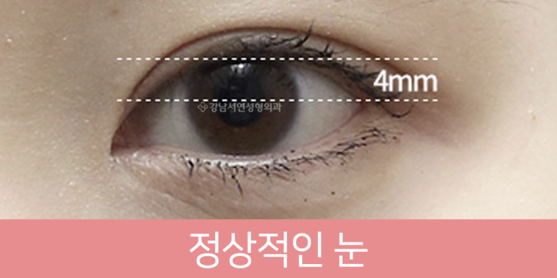 모르면 큰일나는 안검하수, 눈매교정의 모든 것을 알려드려요~