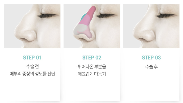 코성형 잘하는 신사역 강남서연 ㄱㄴㅅㅇ_매부리코 수술전후_수술방법