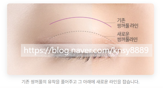 두줄따기 수술이란? 소세지눈 낮추는 원리와 실패없는 눈재수술 기준