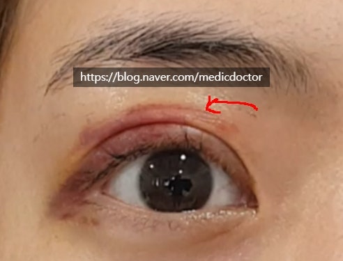 فيديو مراجعة قبل الجراحة، بعد الجراحة مباشرة، وبعد أسبوع لترتيب خطوط التجاعيد المزدوجة (الجفن المزدوج الثلاثي)
