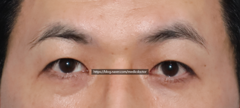 남자 쌍꺼풀 제거, 제가 진료실에서 자주 듣는 이야기 사진 2