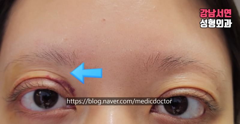 절개법 쌍꺼풀 조기교정, 필요한 경우와 접근 방법 사진 4